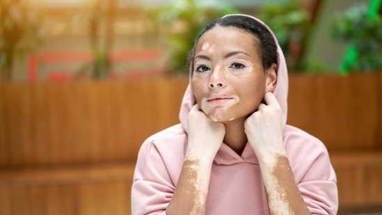 World Vitiligo Day 2025 vitiligo myths and facts skin depigmentation autoimmune skin condition vitiligo awareness June 25 vitiligo prevention vitiligo treatment options skin care for vitiligo dermatologist tips for vitiligo vitiligo diagnosis innovations in vitiligo AI in dermatology vitiligo stigma vitiligo education skin health awareness vitiligo cure vitiligo in children vitiligo facts skin discoloration cause vitiligo non contagious skin