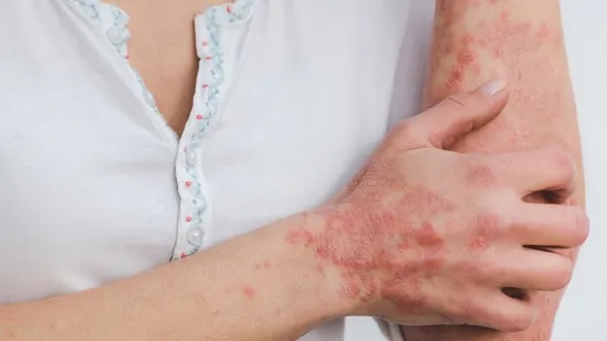 psoriasis psoriasis flare ups psoriasis in monsoon psoriasis symptoms psoriasis treatment psoriasis management psoriasis causes psoriasis care psoriasis cure psoriasis prevention psoriasis diet psoriasis home remedies psoriasis relief psoriasis skin disease psoriasis chronic condition psoriasis autoimmune disorder psoriasis awareness psoriasis dermatologist psoriasis itchy skin psoriasis red patches psoriasis scaly skin psoriasis lesions psoriasis triggers psoriasis in rainy season psoriasis humidity effect psoriasis sunlight effect