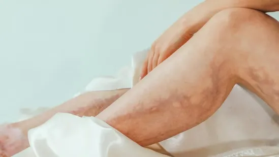 cold feet heart disease swollen ankles heart problem poor circulation symptoms cardiovascular warning signs varicose veins leg swelling PAD peripheral artery disease DVT deep vein thrombosis cold legs poor blood flow signs of poor heart health foot swelling reasons pale feet circulation issues poor vascular health leg pain while walking cramping in legs foot numbness heart disease early signs ankle edema heart and kidney problems varicose veins causes red calf swollen calf DVT signs vein blockage lower limb swelling poor