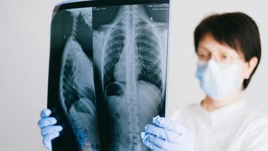 World Cancer Day 2026 lung cancer myths lung cancer awareness lung cancer India lung cancer symptoms lung cancer causes lung cancer treatment lung cancer early detection lung cancer non smokers lung cancer air pollution lung cancer women lung cancer survival lung cancer diagnosis lung cancer facts lung cancer