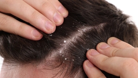 dandruff types dandruff treatment scalp care dandruff causes oily dandruff dry dandruff itchy scalp dandruff solution anti dandruff shampoo scalp health hair care tips dandruff