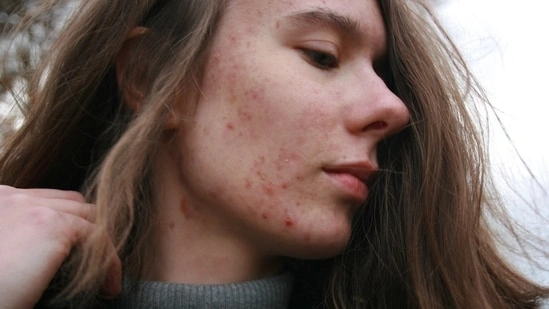 hormonal acne treatment gut health acne soluble fibre acne clear skin diet acne gut skin connection acne UK surgeon advice acne natural remedy acne hormone balance acne oestrogen dominance acne jawline acne